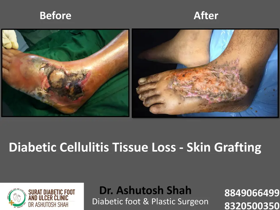 Diabetic Cellulitis and Coverage.pptx-4.webp